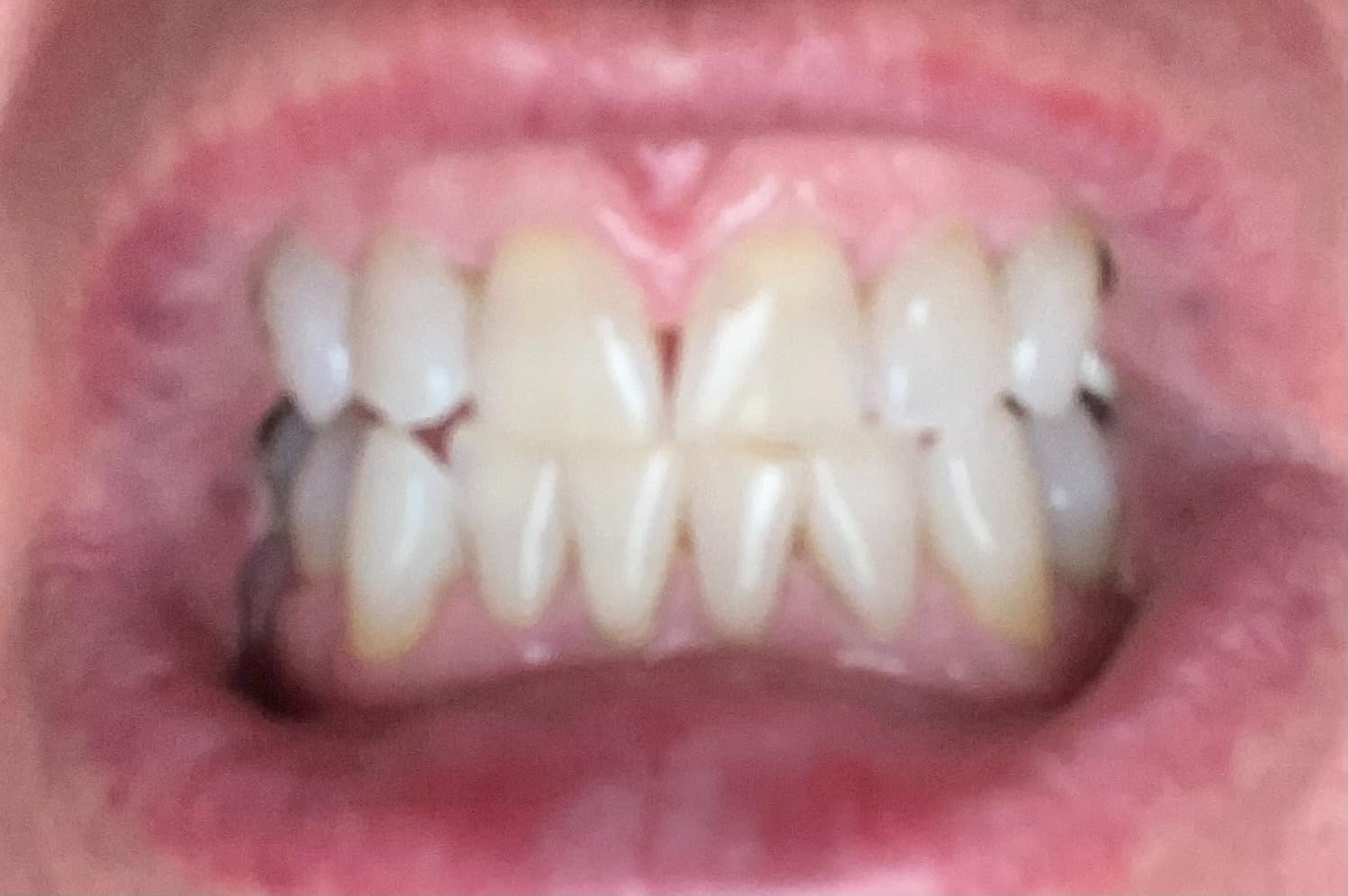 Plus White Premier Whitening System - 5 Minute Speed Whitening Gel, Comfort Fit Mouth Tray & StainGuard Post - Dentist Approved & Professional Grade (2 oz Tube, Mouth Tray and 4 oz Post Rinse) customer photo 2