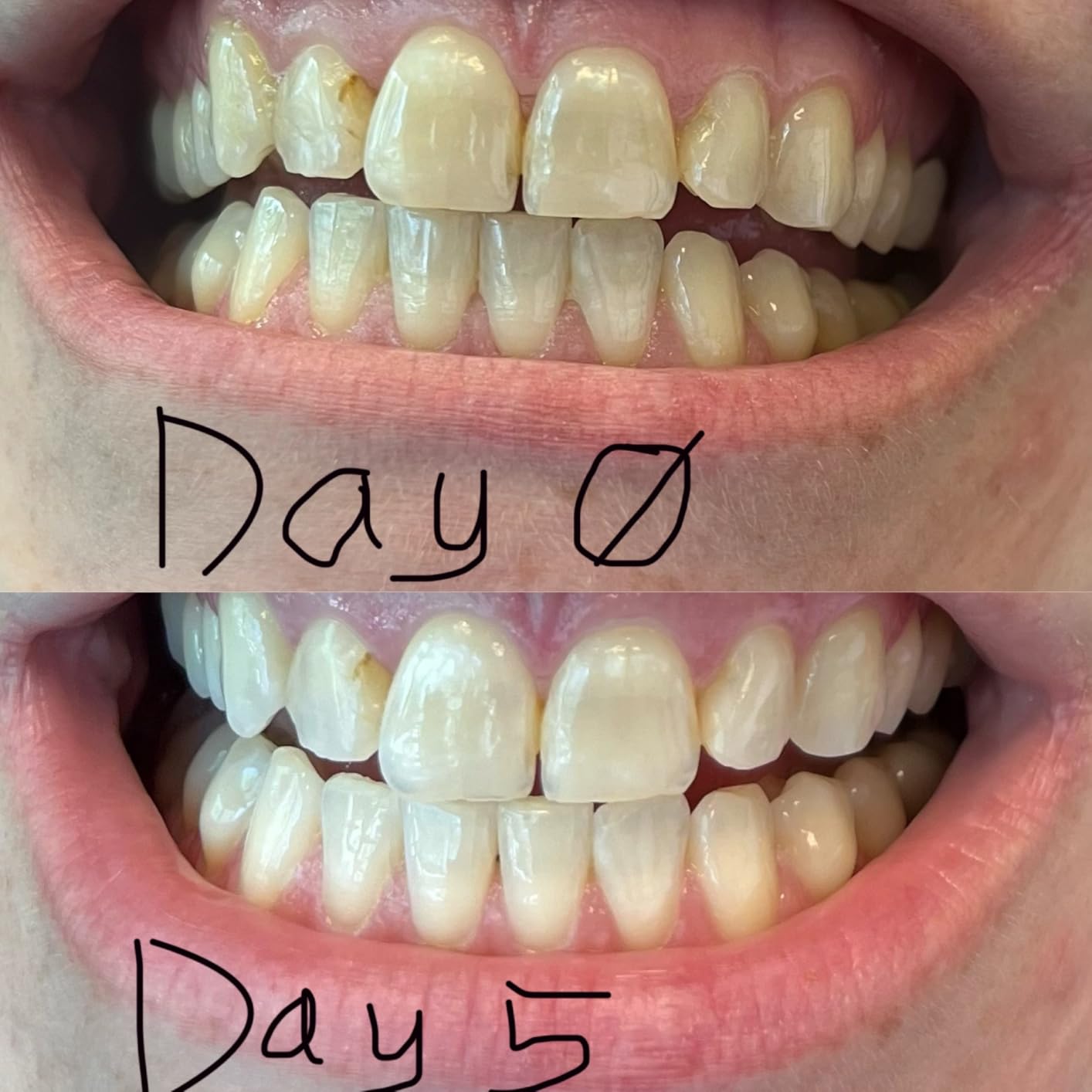Opalescence Go 15% Mint - Prefilled Teeth Whitening Trays - 5194 customer photo 1