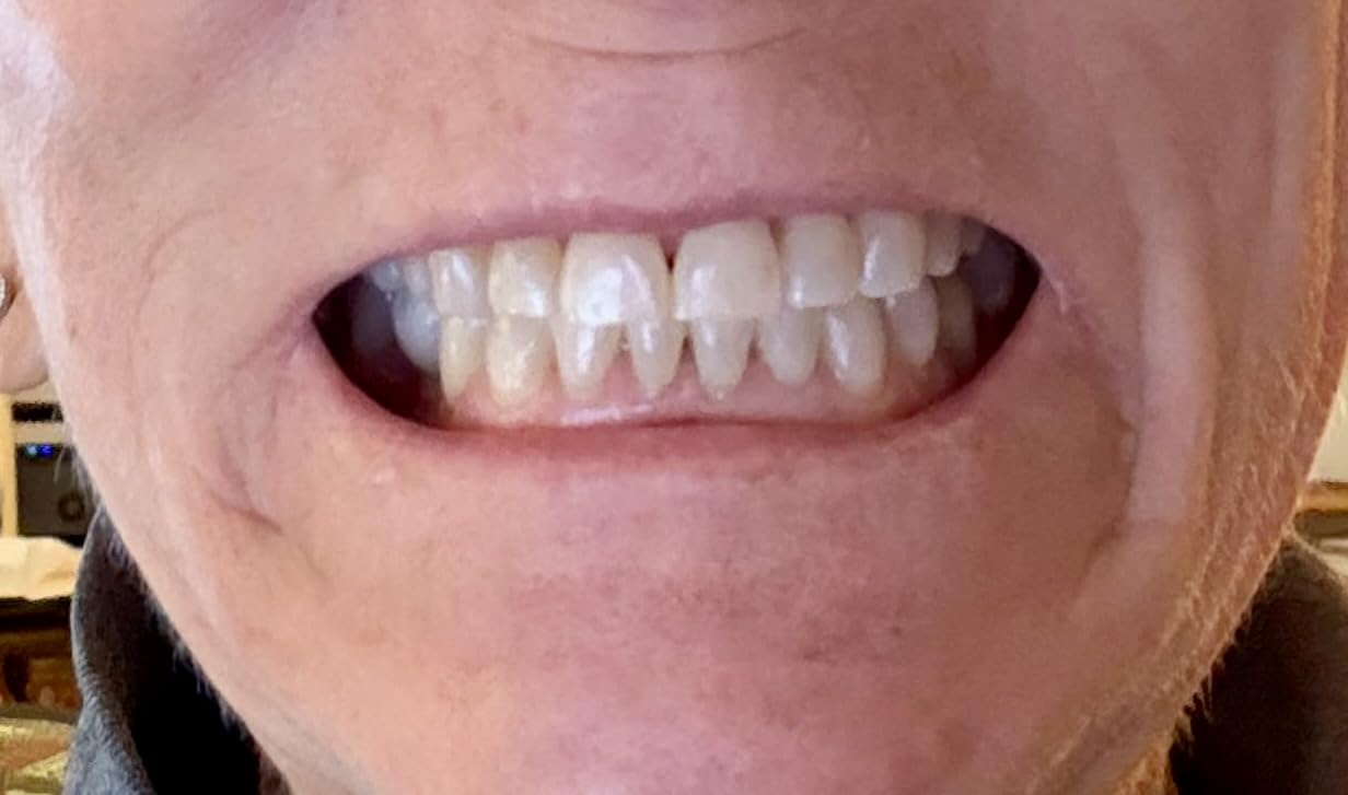 Crest 3DWhitestrips Sensitive White At-Home Teeth Whitening Kit, 18 Treatments, Gently Removes 15 Years of Stains customer photo 2