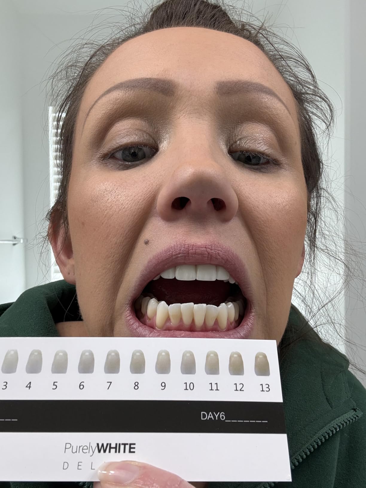 PurelyWHITE DELUXE Teeth Whitening Kit, Complete LED Teeth Whitening, 15+ Treatments, (3) 3ml Whitening Gel Syringes, Whiter Smile in 7 Minutes customer photo 2