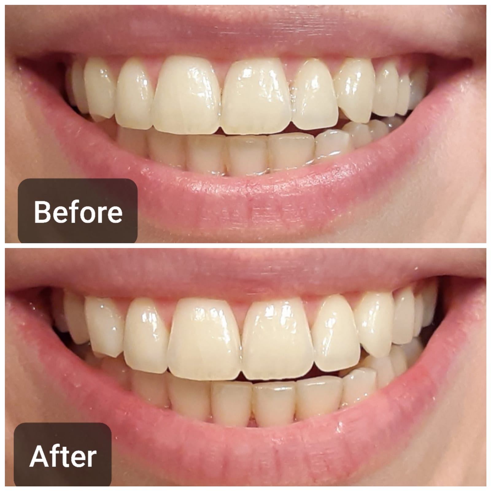 Auraglow Plug-in LED Teeth Whitening Kit – Wired Light Device – 35% Carbamide Peroxide Gel – 12 Treatments – at-Home Tooth Whitening System – Enamel-Safe at-Home Whitening for Coffee & Tea Stains customer photo 1