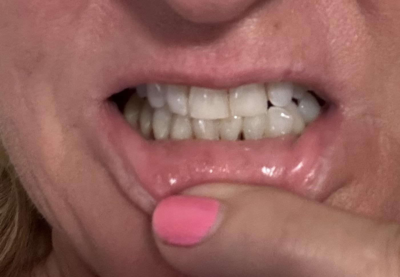 Auraglow Plug-in LED Teeth Whitening Kit – Wired Light Device – 35% Carbamide Peroxide Gel – 12 Treatments – at-Home Tooth Whitening System – Enamel-Safe at-Home Whitening for Coffee & Tea Stains customer photo 2