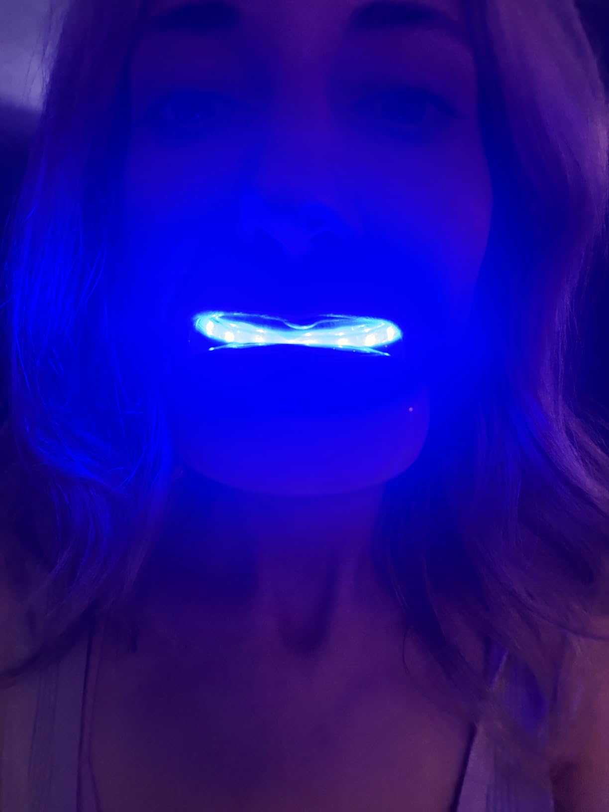 Whitebite Pro Teeth Whitening Kit for Sensitive Teeth – 32X LED Light + 35% Carbamide Peroxide Gel + Remineralizing Gel | Dental-Grade Whitening at Home customer photo 2